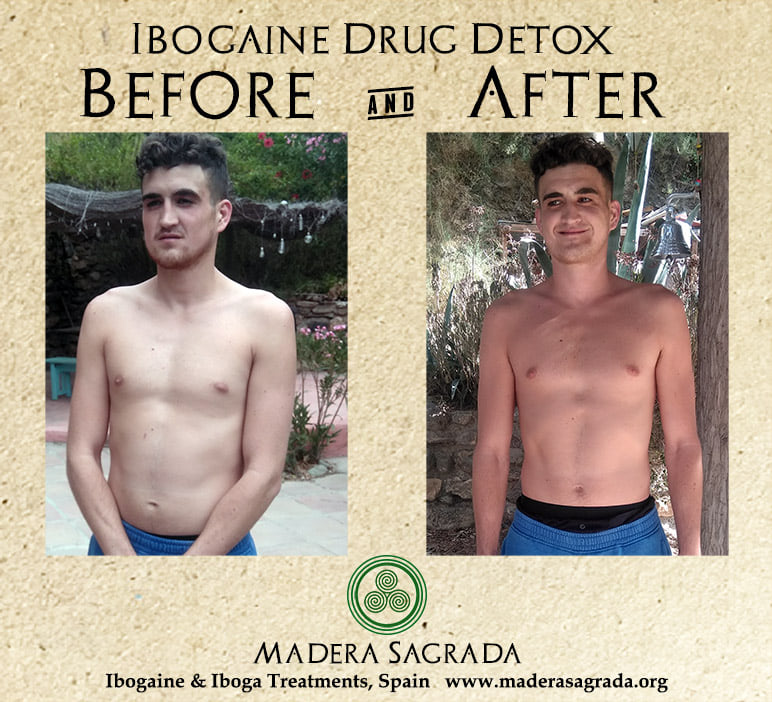 Before/after ibogaine drug detox, Spain, Europe